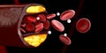 3d Illustration of blood cells with plaque buildup of cholesterol black