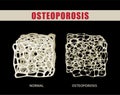 3D illustration comparing osteoporosis with normal bone on black background