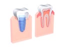 3d illustration of a dental implant in a gum, next to a normal tooth.