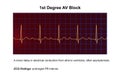 ECG of 1st degree AV block, 3D illustration