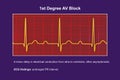 ECG of 1st degree AV block, 3D illustration