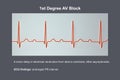 ECG of 1st degree AV block, 3D illustration