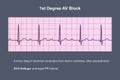 ECG of 1st degree AV block, 3D illustration