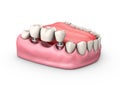 3d Illustration of a Fixed partial denture bridge, isolated white Royalty Free Stock Photo