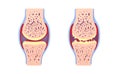 3d illustration of healthy synovial joint and with osteoarthritis.