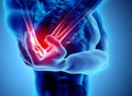 3d illustration of human elbow injury.