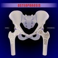 3D illustration of a human hip bone comparing the inside of normal bone symptoms with osteoporosis