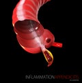 3D illustration of inflammation Appendicitis, human anatomy isolated black