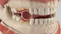 3D Illustration of Jawbone with Missing Tooth Socket and Bone Resorption image Royalty Free Stock Photo