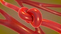 Knot in an artery being constricted and narrowed called arteriosclerosis Royalty Free Stock Photo