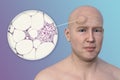 Lipoma on a man's forehead, 3D illustration and micrograph Royalty Free Stock Photo