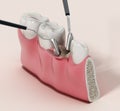 3D illustration of mid-crestal incision dental operation. 3D illustration