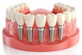 Multiple dental implants replacing lower jaw teeth. Full arch restoration with crown prosthetics and visible screw components Royalty Free Stock Photo
