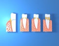 3d illustration of paper teeth with tartar. Showing four different phases in which it evolves and the gums