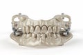 3D illustration of prosthodontics concept of removable partial denture. Royalty Free Stock Photo