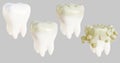 3d illustration render of tooth enamel destruction in stages caries
