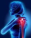 Shoulder painful skeleton x-ray, 3D illustration.