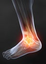 Osteoarthritis, painful ankle joint, 3D illustration Royalty Free Stock Photo