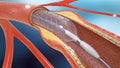 Stent implantation for supporting blood circulation into blood vessels