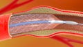 Stent implantation for supporting blood circulation into blood vessels Royalty Free Stock Photo