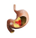 3d illustration of Stomach ulcer, human stomach anatomy Royalty Free Stock Photo