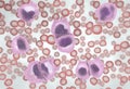 Strong increase of non-functional white blood cells called leukemia cells leading to blood cancer disease