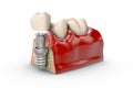 3d illustration of tooth dental implant model Royalty Free Stock Photo