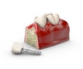 3d illustration of tooth dental implant model Royalty Free Stock Photo