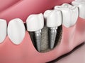 3D illustration of two dental implants on the lower jaw