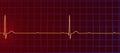 ECG of 3rd degree AV block, 3D illustration