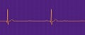 ECG of 3rd degree AV block, 3D illustration