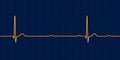 ECG of 3rd degree AV block, 3D illustration