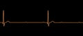 ECG of 3rd degree AV block, 3D illustration