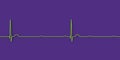 ECG of 3rd degree AV block, 3D illustration