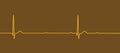 ECG of 3rd degree AV block, 3D illustration