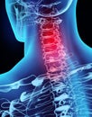 3D illustration x-ray neck painful. Royalty Free Stock Photo