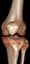 3D CT Volume Rendering Knee