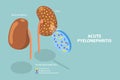 3D Isometric Flat Vector Conceptual Illustration of Acute Pyelonephritis Royalty Free Stock Photo