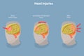 3D Isometric Flat Vector Conceptual Illustration of Brain Injuries