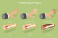 3D Isometric Flat Vector Conceptual Illustration of Frostbite Stages Of Fingers