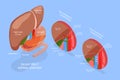 3D Isometric Flat Vector Conceptual Illustration of Gallbladder Removal Surgery Royalty Free Stock Photo