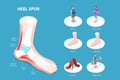 3D Isometric Flat Vector Conceptual Illustration of Heel Spur