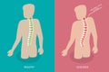 3D Isometric Flat Vector Conceptual Illustration of Scoliosis Royalty Free Stock Photo
