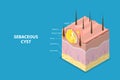 3D Isometric Flat Vector Conceptual Illustration of Sebaceous Cyst Royalty Free Stock Photo
