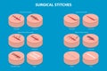 3D Isometric Flat Vector Conceptual Illustration of Surgical Stitches