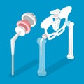 3D Isometric Flat Vector Conceptual Illustration of Total Hip Replacement