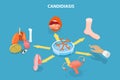 3D Isometric Flat Vector Illustration of Candidiasis