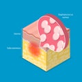 3D Isometric Flat Vector Illustration of Cellulitis