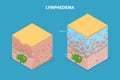 3D Isometric Flat Vector Illustration of Lymphedema