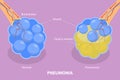 3D Isometric Flat Vector Illustration of Pneumonia Royalty Free Stock Photo